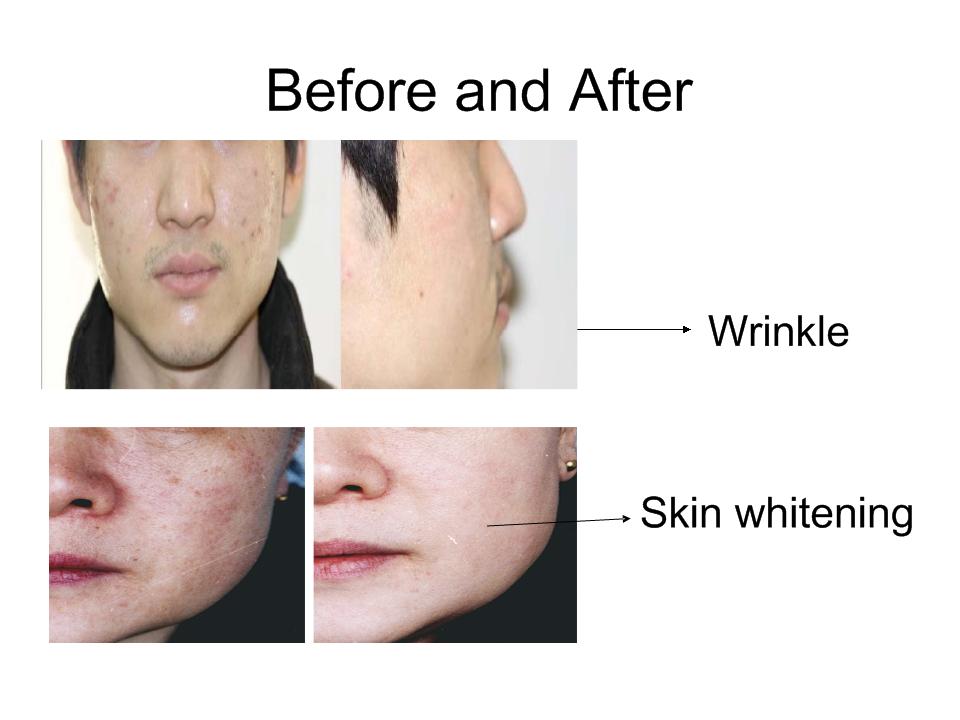 High Technology Safely Treat All Skin Types Fractional Rf Radiofrequency Microneedling Beauty Equipment High Technology Safely Treat All Skin Types Fractional Rf Radiofrequency Microneedling Beauty Equipment