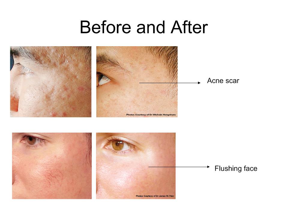 High Technology Safely Treat All Skin Types Fractional Rf Radiofrequency Microneedling Beauty Equipment High Technology Safely Treat All Skin Types Fractional Rf Radiofrequency Microneedling Beauty Equipment