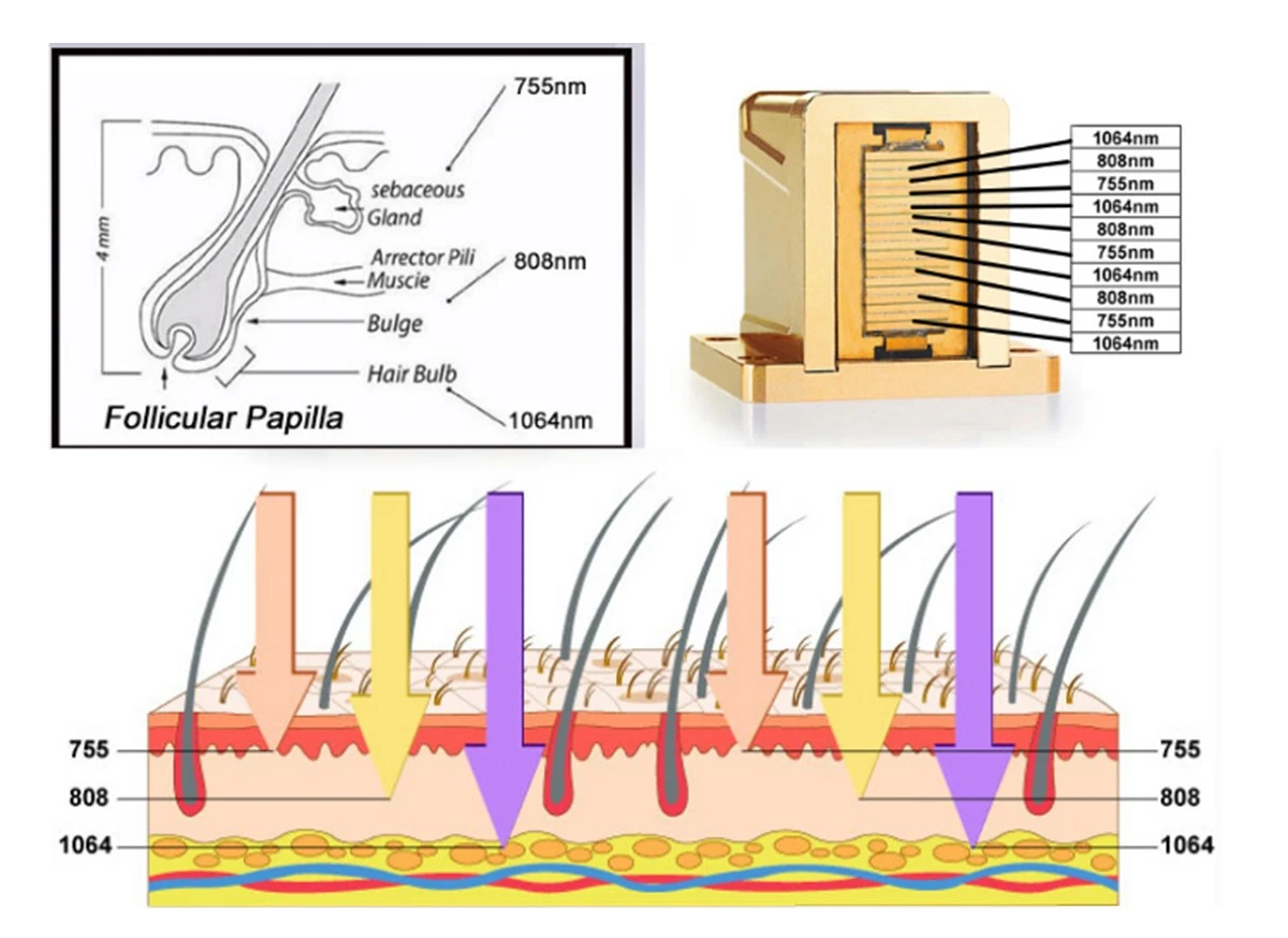 triple wavelength diode laser triple wavelength diode laser